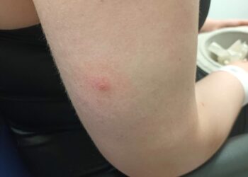 Aumentan los casos de “needle spiking” en espacios públicos​