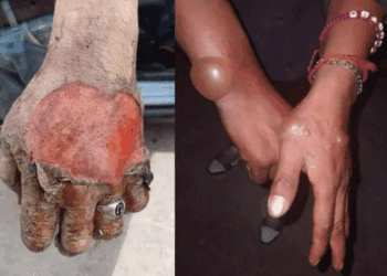 Voluntarios en Chihuahua enfrentan heridas graves al combatir incendios