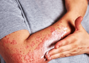 Casos de sarampión se duplican en una semana; suman 126 en México