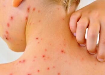 Brote de sarampión en EU supera los mil casos en 2025