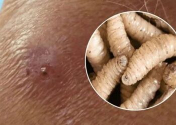 Confirman brote de gusano barrenador en humanos en Honduras: van 41 casos