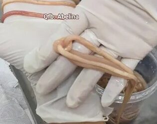 Sacan más de 140 parásitos del cuerpo de un niño de siete años