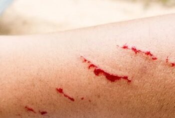 Paciente con rabia por mordedura de zorrillo