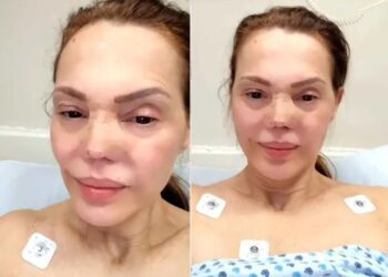 Carmen Campuzano se somete a cirugía nasal tras accidente con lentes