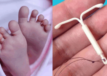 Bebé nace en Brasil sosteniendo el DIU que debía evitar su embarazo