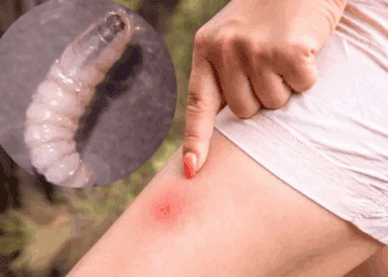 Yucatán confirma segundo caso de miasis por gusano barrenador en humanos