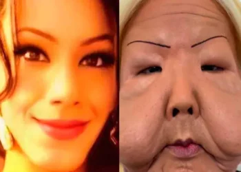 Influencer inicia reconstrucción facial tras procedimiento ilegal