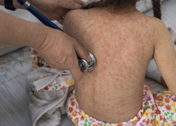 ¡ALERTA POR SARAMPIÓN! Gobierno de México comprará 15 millones de vacunas tras brote de 9 mil casos en el país